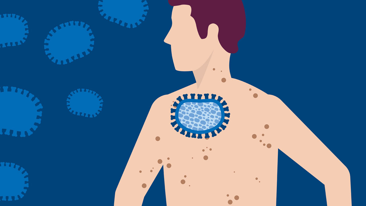 Monkeypox virus illustration