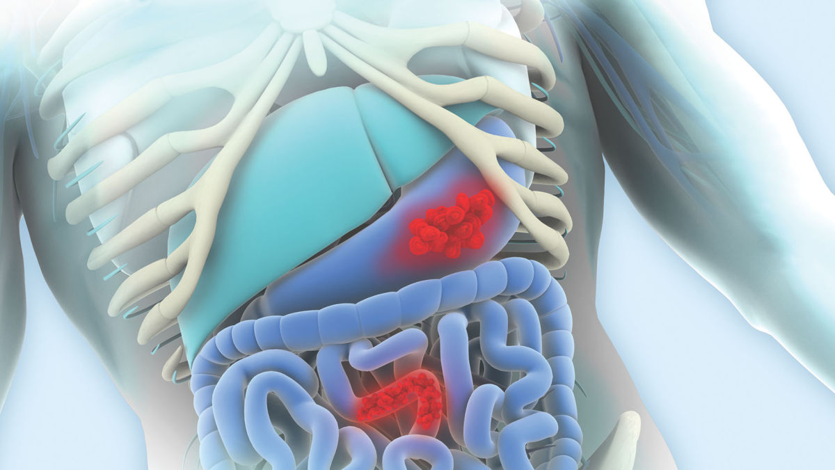 Reliably detect PDGFRA mutations