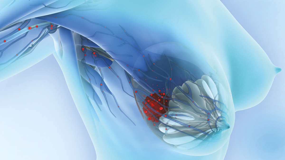 Breast cancer metastasis